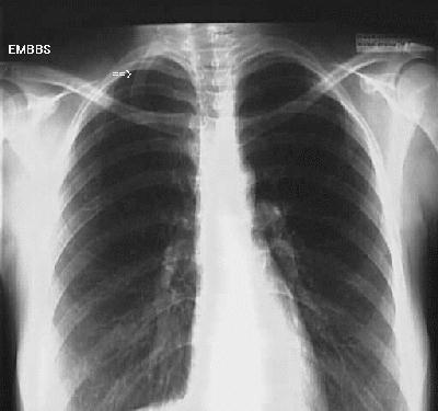 cxr.jpg (16849 Byte)